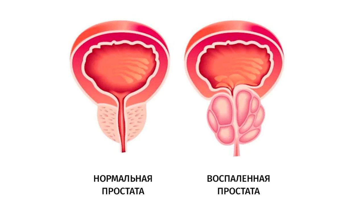 A prosztatáról és a prosztatitisről prostatitis és jelei
